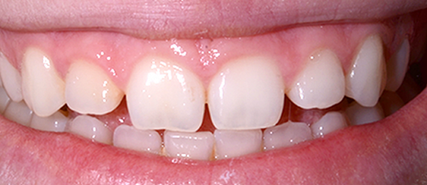Лечение кариеса, художественная реставрация зубов, удлинение клинической коронки до
